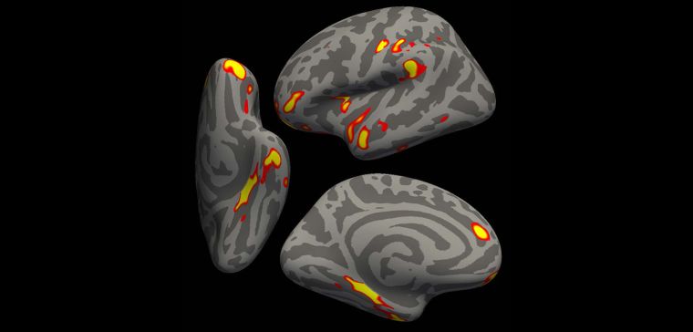 Infected vs non-infected grey matter thickness (a brain scan image)