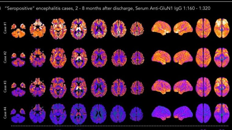 Brain scans of patients with NMDAR-antibody encephalitis
