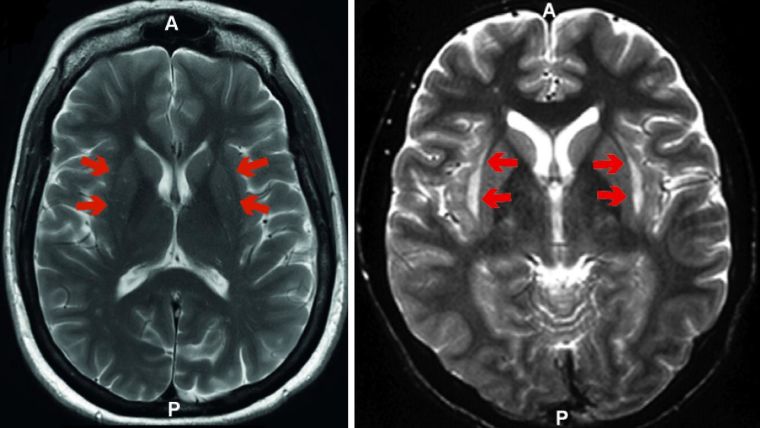 A representative T2-weighted image of a healthy human brain (red arrows indicate the claustrum) compared with a T2-weighted image showing a lesion reported as affecting the claustrum.