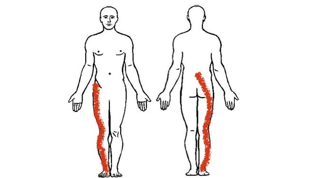 Example of two pain drawings of patients with sciatica. The first patient has pain going from the groin area to the foot. The second patient has pain going from the lower back to the foot. The distribution of pain can vary substantially between patients.