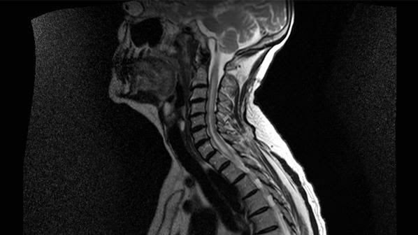 Sagittal MRI image of the cervical cord in an NMO patient, showing longitudinally extensive T2 high signal from the cervico-medullary junction to T2